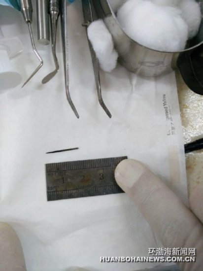 醫(yī)生取出的縫衣針。