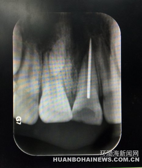 X光片顯示縫衣針扎入牙齒根管。