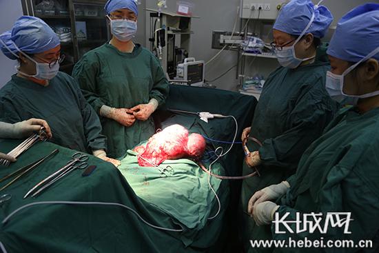 大型子宮肌瘤。